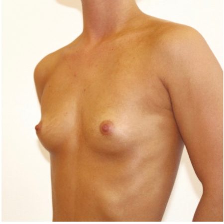 Før og efter billeder brystforstørrelse