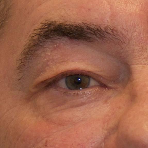 oejenlaaagsoperation_foer2