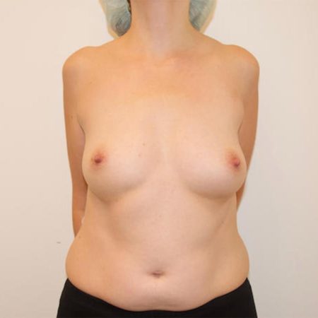 Hos Pfeiffer plastikkirurgi tilbyder vi brystforstørrelse med motiva før billede