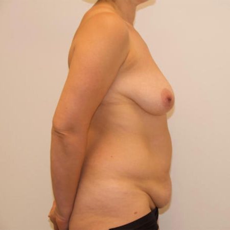 Pfeiffer plastikkirurgi - mommy makeover og brystløft før billede fra siden