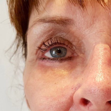 Pfeiffer Plastikkirurgi - reduktion af nedre og øvre øjenlåg efter billede