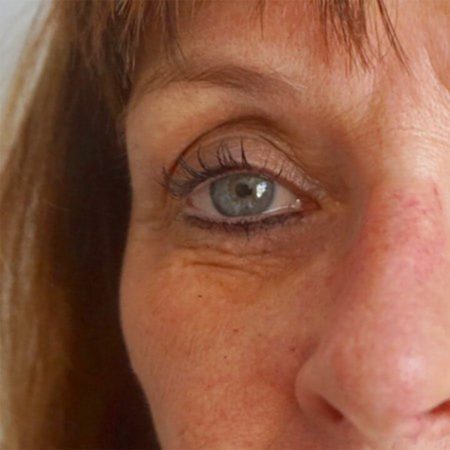Pfeiffer Plastikkirurgi - reduktion af nedre og øvre øjenlåg før billede