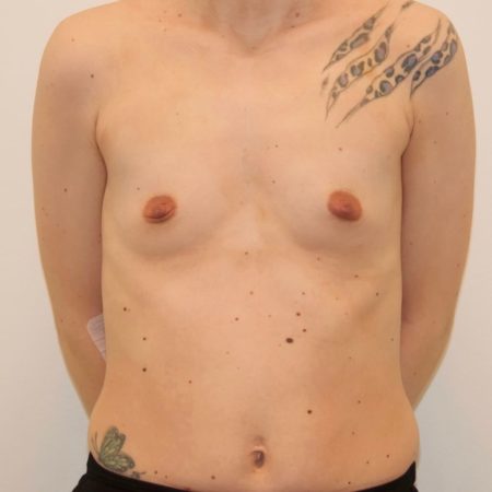 Hos Pfeiffer plastikkirurgi tilbyder vi brystforstørrelse. Her er et efter billede forfra.