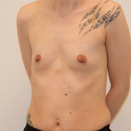 Hos Pfeiffer plastikkirurgi tilbyder vi brystforstørrelse. Her er et efter billede fra siden.