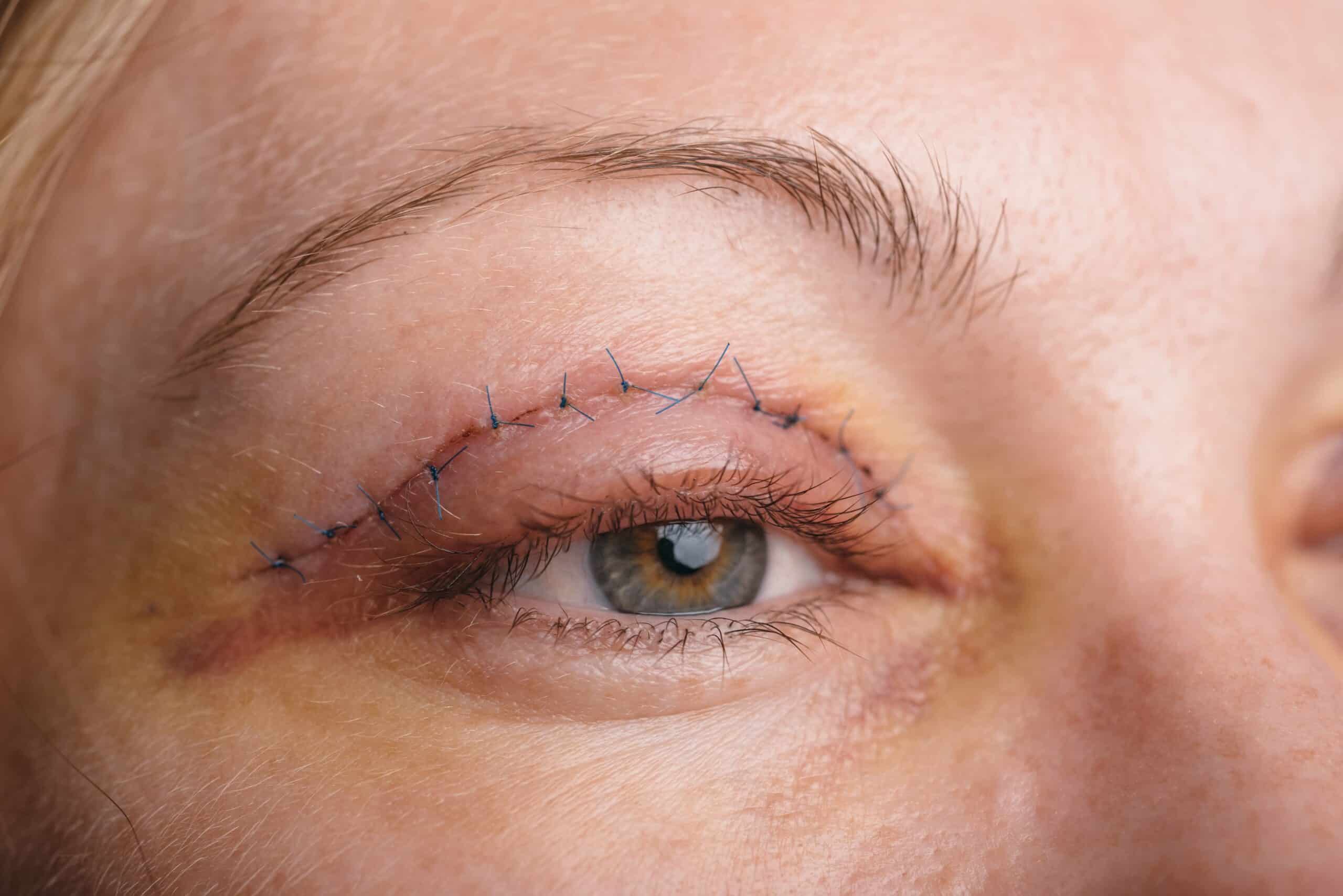 blepharoplasty-upper-eyelid-operation-that-removes-excess-ugly-skin-eyelids-eyes-photos-show-seams-this-is-third-day-after-operation-min