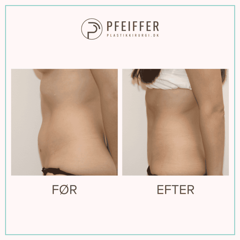 fedtsugning-foer-efter-pfeiffer