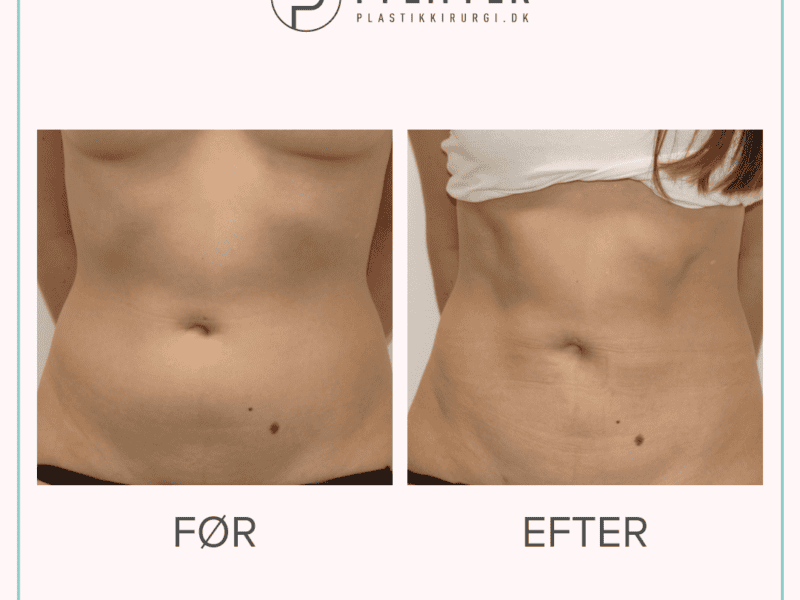 fedtsugning-foer-efter