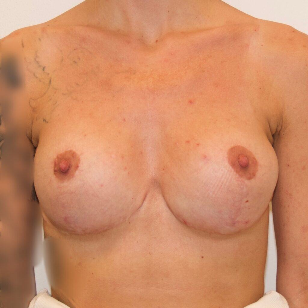 Patientcase efter Udskiftning af 600 ml implantater til 275 ml med brystløft – et resultat der passede til patientens krop